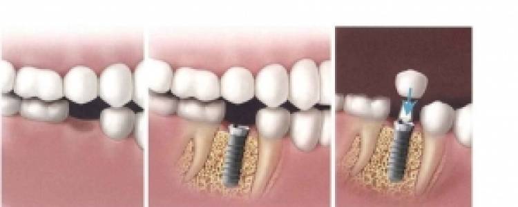 Dental Implant