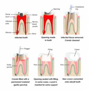 Root canal procedure
