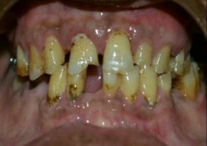 Full Mouth Rehabilitation