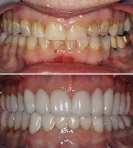 Full Mouth Rehabilitation