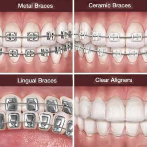 ORTHODONTIC TREATMENT