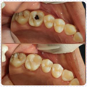 Restorative dentistry (Dental Filling)