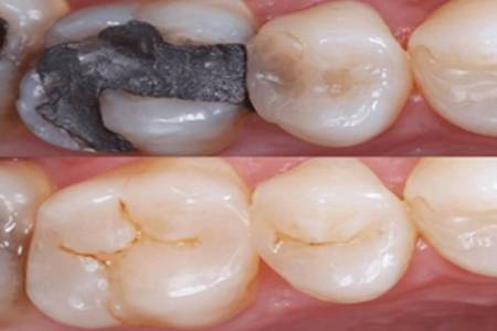 Tooth Coloured Restoration