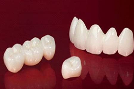 Fixed Teeth (Crown And Bridges)