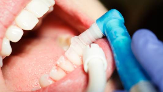 Teeth Cleaning in Bharuch