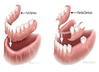 Complete & Partial Dentures