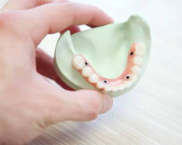 dental implants