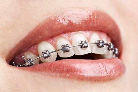 Orthodontic