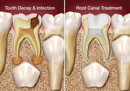 Root Canal Treatment