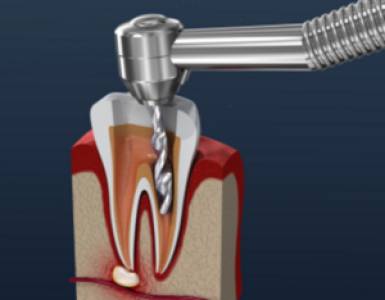 Root Canal Treatment