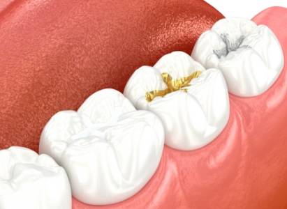 Dental Fillings / Teeth Fillings