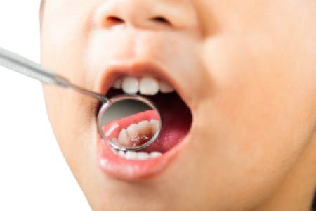 Child Dental Care