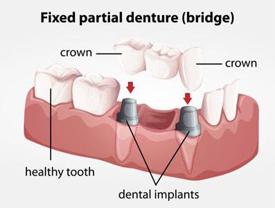 Dental Fillings
