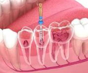 ENDODONTIC SURGERY