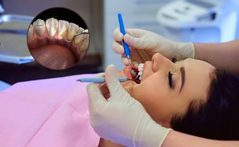 Teeth Cleaning Treatment