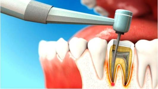 PAINLESS ROOT CANAL TREATMENT PUNE CAMP
