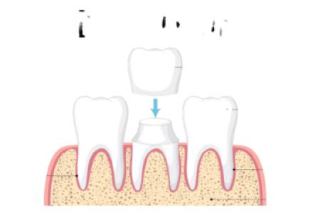 DENTAL BRIDGES