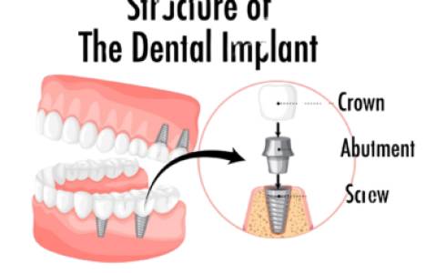 DENTAL IMPLANTS