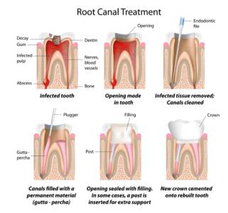 Root Canal Therapy