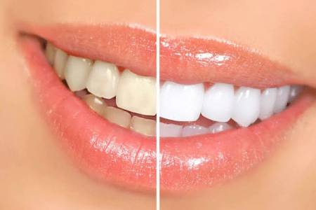 Teeth Whitening in Pune