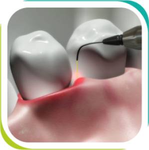 Laser Dentistry