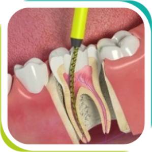 Root Canal Treatment