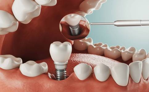 Single Tooth Implant