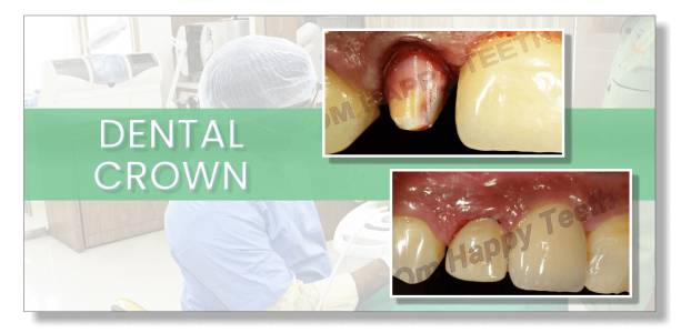 Crown & Bridge Treatment Pimple Saudagar