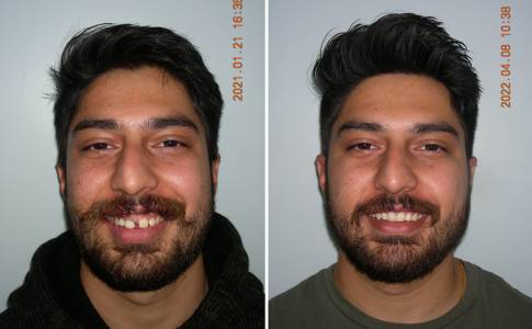 about orthodontic treatment