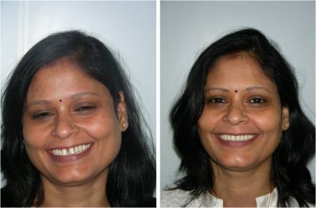 Orthodontics for Adults