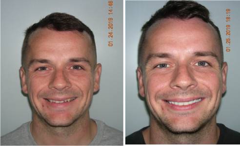 cosmetic smile makeovers