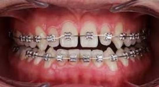 traditional braces