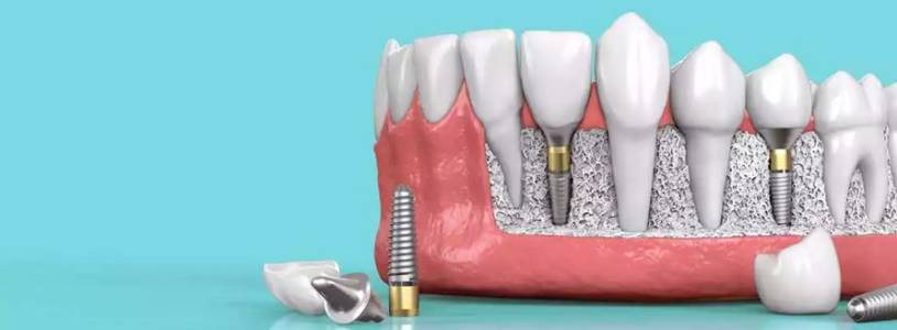 dental implants