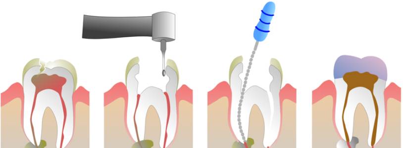 Root Canal