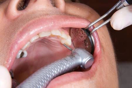 Dental Filling
