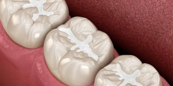 dental filling