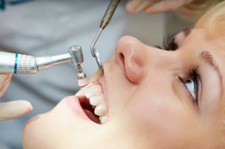 Teeth Cleaning (Scaling & Polishing)