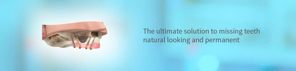 Graftless Implants (TTPHIL)