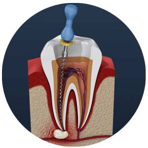 ROOT CANAL TREATMENT