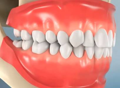 WISDOM TEETH REMOVAL