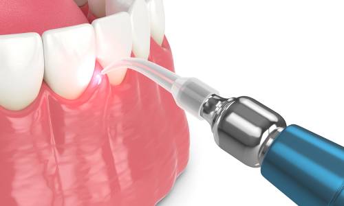 Periodontal (Gum) Treatment