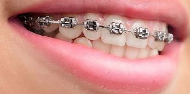 Traditional Metal Braces