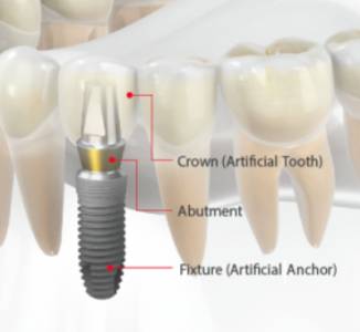 Dental Implants in Pune