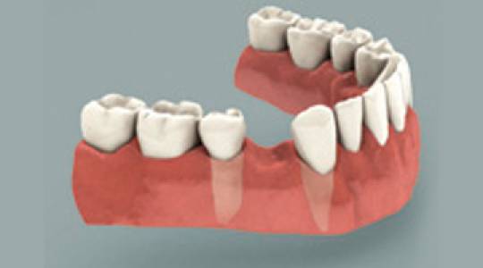 Untreated Missing Tooth