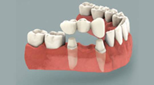 Traditional Crown & Bridge