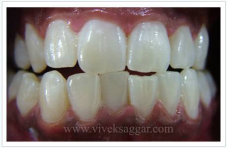tooth whitening