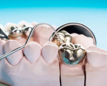 Filling and Restorations