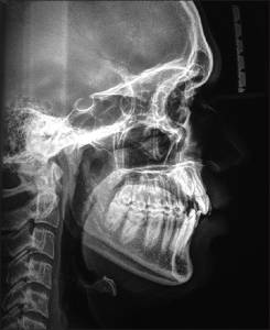 Dental X-Rays