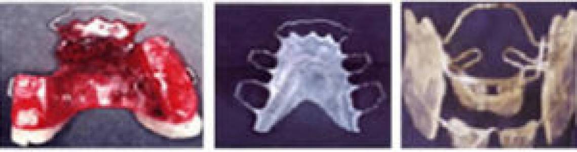 Dental Braces (Orthodontics)