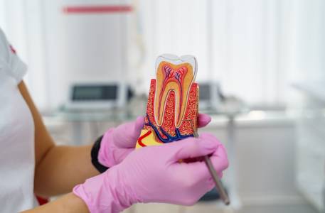 Root Canal Treatment (RCT)